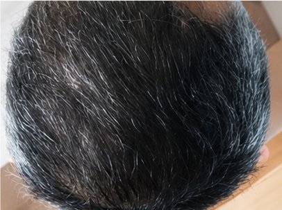After: a fuller crown