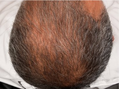 Before: a thinning crown