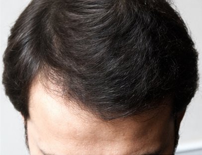 After: male hairline comparison
