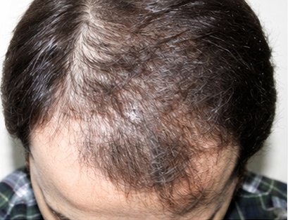 Before: male hairline comparison