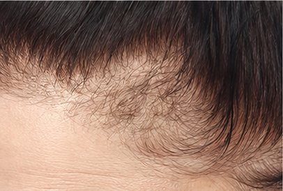 Before: thinning temples
