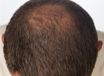 After: supplied crown comparison