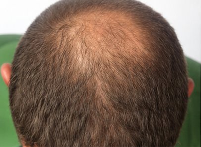 Before: supplied crown comparison
