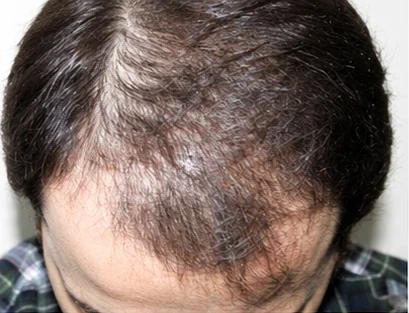 Before: original hairline comparison photo
