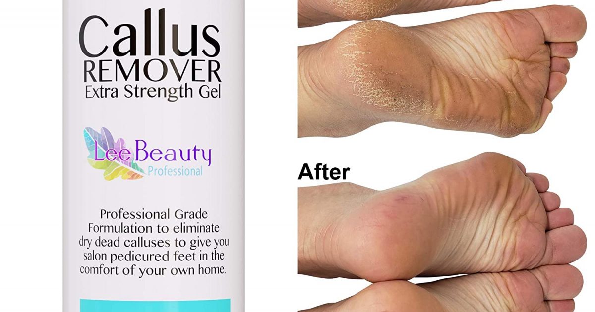  Callus Remover for Feet with Extra Strength Gel & Foot Pumice  Stone Set - Easy Way to Remove Hard Calluses & Dead Skin Build-Up -  Professional at-Home Foot Care for Men