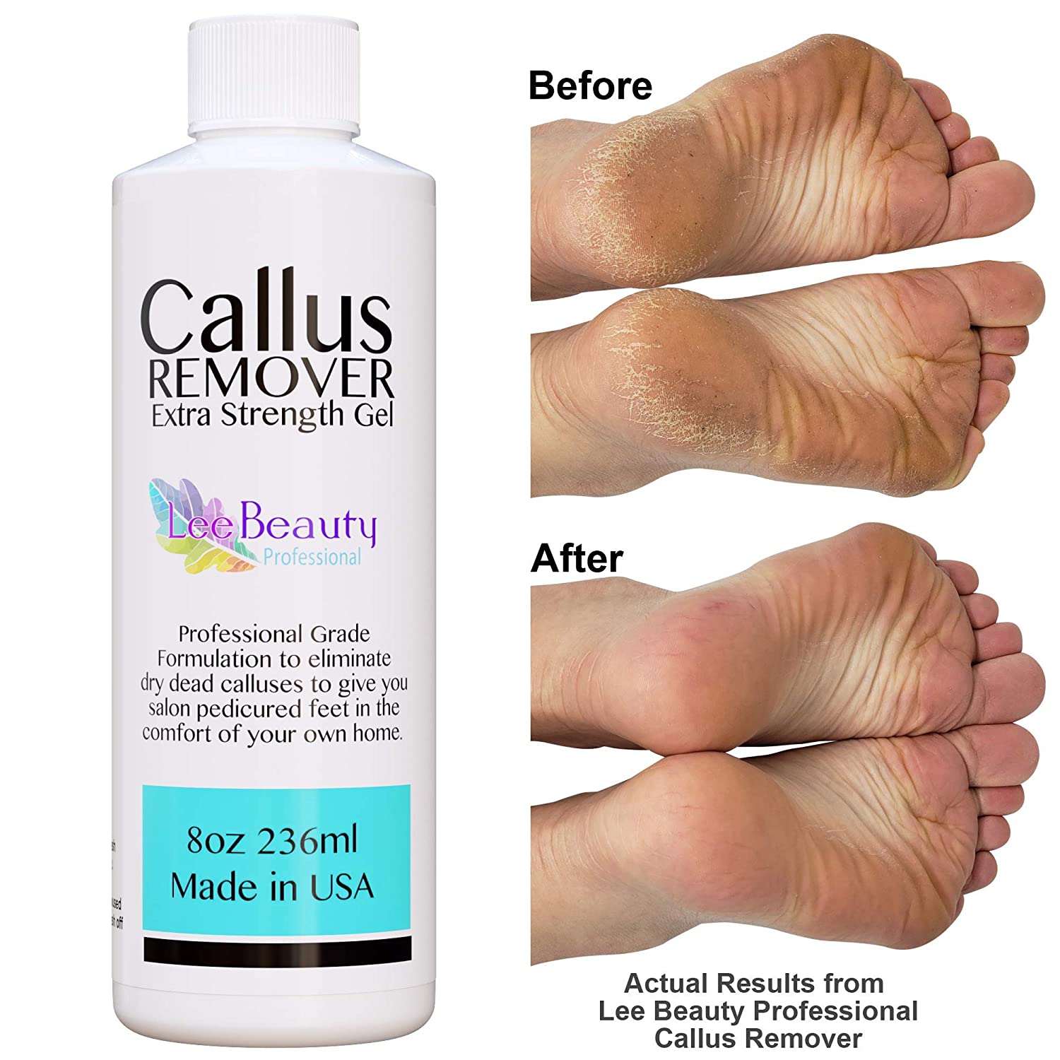 8oz Callus Remover Gel For Feet ⋆ Bold-Products USA