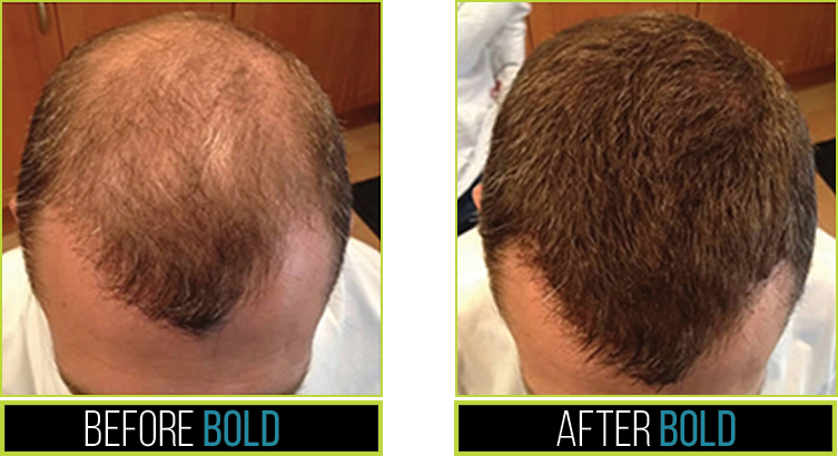 10. Boldify Hair Thickening Fibers - Hair Loss Concealer for Thinning Hair - 100% Natural Keratin Hair Building Fibers for Men & Women - Auburn - wide 6