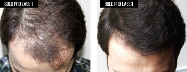 Before-and-after hairline photos from the existing BOLD laser cap gallery; before on the left, after on the right