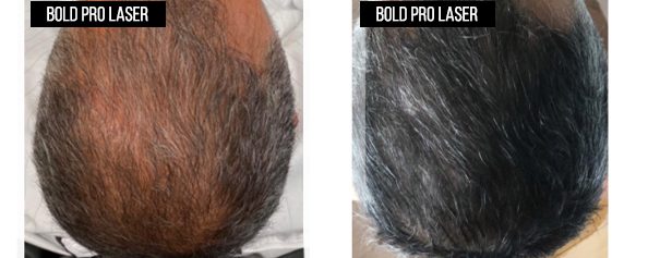 Before-and-after crown photos from the existing BOLD laser cap gallery; before on the left, after on the right