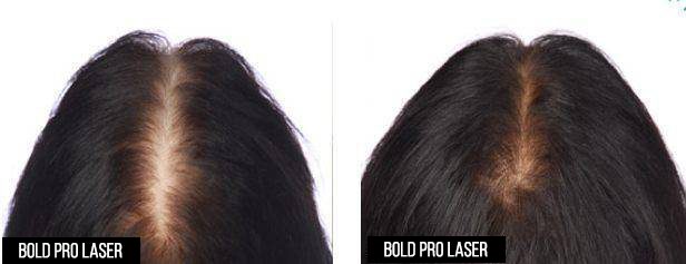 Before-and-after part-line photos from the existing BOLD laser cap gallery; before on the left, after on the right