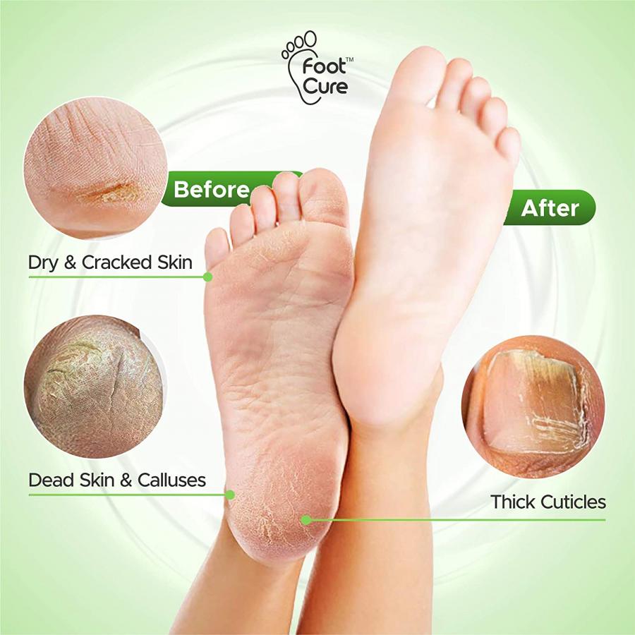 Foot Cure Callus Remover Gel Kit BoldProducts Instant Lifestyle